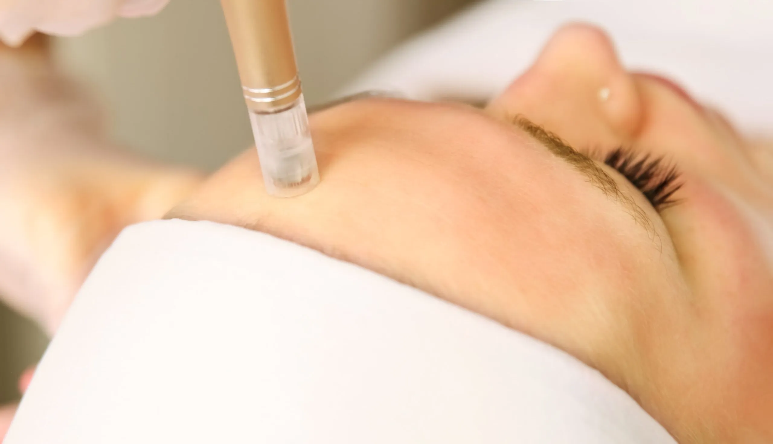 Mikroneedling Proseduru